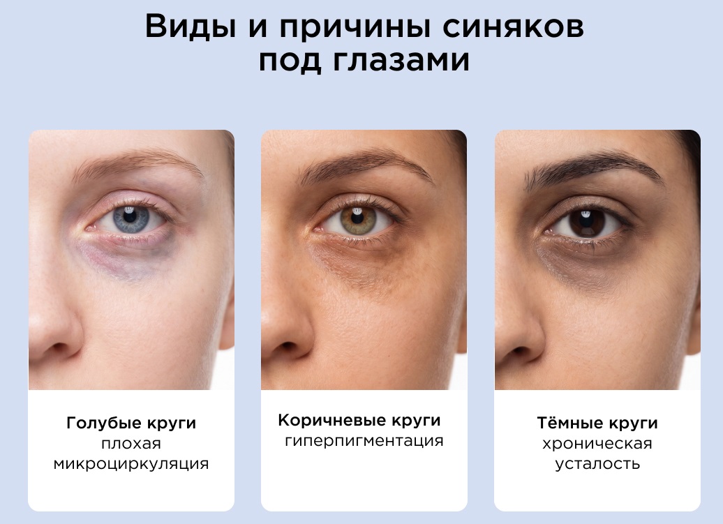 Основные причины темных кругов под глазами: пигментация, сосуды, носослезная борозда и отек