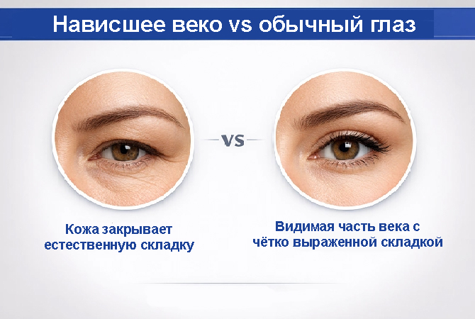 Схема нависшего века и области брови