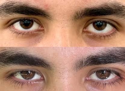 Нижний scleral show: отсутствие, небольшой и выраженный показ белка под радужкой